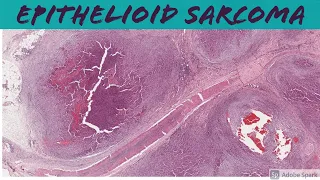 Epithelioid Sarcoma: 5-Minute Pathology Pearls