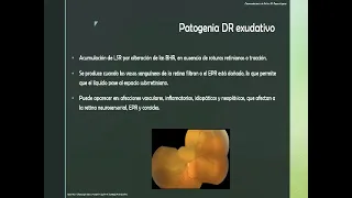 Desprendimiento de retina traccional. Dra. Gusmary Hernández