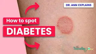 Diabetes SPOT THE Key Signs to Watch Out For - Doctor explains