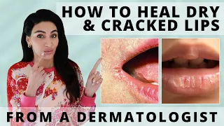 How to Heal Dry & Cracked Lips Fast | Dermatologist Reveals
