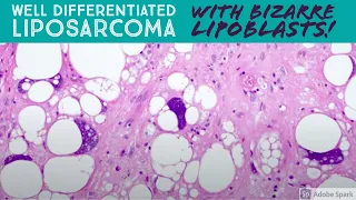 Well differentiated liposarcoma with BIZARRE pleomorphic lipoblasts! 5-Minute Pathology Pearls