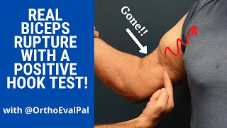 Biceps Rupture with a Positive Hook Test!