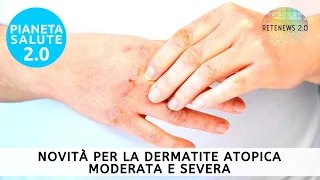 Tralokinumab novità per la dermatite atopica moderata e severa.