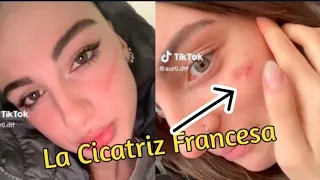 La Cicatriz Francesa o el reto de TikTok
