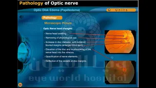 optic disk edema papilledema