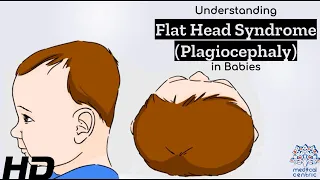 Flat Head Syndrome Explained: Causes, Symptoms, and Solutions