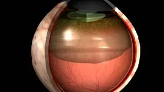 Desprendimiento de vítreo posterior - evrs