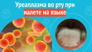 👅 Уреаплазма во рту при налете на языке. Клинический случай №1389