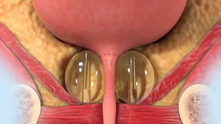 ProACT Animation for Patients