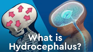 What is Hydrocephalus and Why Does Fluid Build Up in the Brain?