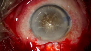 Priorities: Manual Small Incision Cataract surgery (SICS) in an elderly patient.