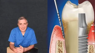Что лучше? Зуб или имплантат(имплант)? (часть3) Пародонтит и Имплантация