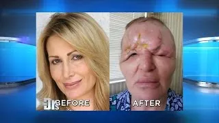 Woman Claims Cosmetic Injections Disfigured Her Face