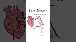 Heart Attacks Explained #healthsketch #shorts