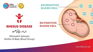 Rhesus disease | Mismatch between Mother and Baby Blood Group