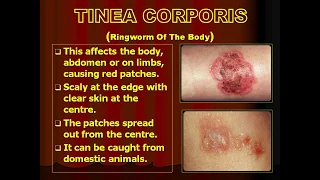 An Overview of Fungal Skin Infections || Skin Infections || How to treat Skin Infections