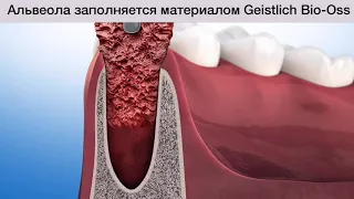 Что делать после удаления зуба? Видео для пациентов (RUS)