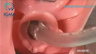Intubación Endotraqueal