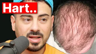 Kevin bereut bereits nach 2 Jahren seine Haartransplantation