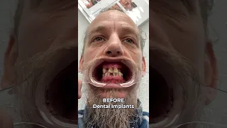 Before And After Smile Transformation! 🤯 Full Mouth Dental Implants! 🦷✨ #shorts