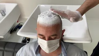 Saç Ekimi Sonrası İlk Yıkama ve Losyon Sürme. First Washing and Lotion Apply After Hair Transplant