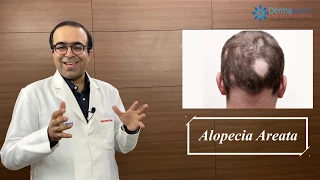 ALOPECIA AREATA Symptoms, Causes & Treatments | Dr Rohit Batra | Permanent Cure