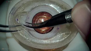 Bioniko eye model GoreTex IOL suture technique Lukan Mishev