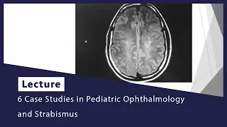 6 Case Studies in Pediatric Ophthalmology and Strabismus