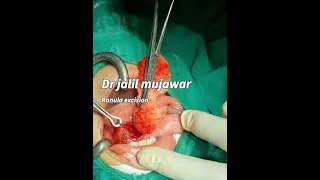 ranula . sublingual mucous cyst .excision. dr jalil mujawar