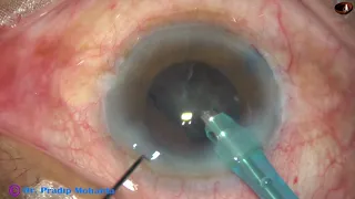 Hard cataract with pseudoexfoliation, mid-dilated pupil and weak zonule : PM, 12/8/2019