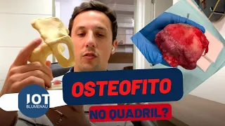 Osteofito (BICO de PAPAGAIO) no Quadril