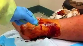 Nail Gun Foot Injury with Dr. ER