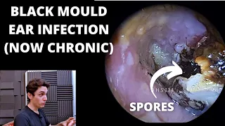 Black Mould Infection Is Now Chronic (Otomycosis)