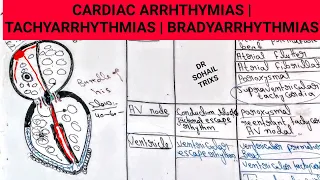 Arrhythmias | Tachyarrhythmias | bradyarrhythmias