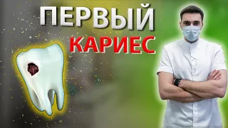 ЗУБЫ КОТОРЫЕ, ПОРАЖАЮТСЯ КАРИЕСОМ САМЫЕ ПЕРВЫЕ! Как предотвратить?