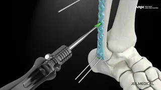 [ARIX OS] ARIX Distal Fibula Surgical Guide