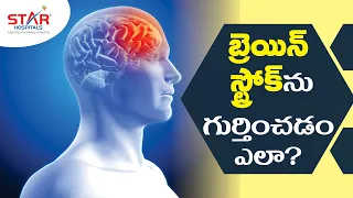 Brain Stroke: Symptoms, Causes, Treatment & Preventive Measures