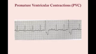 Premature Contractions and Excitations - CRASH! Medical Review Series
