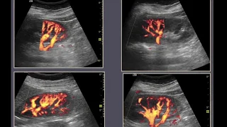 TMT: RENAL DOPPLER PART II