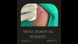 Mole Removal- Surgical Way by Dr.Anvika - DrAnvika.com