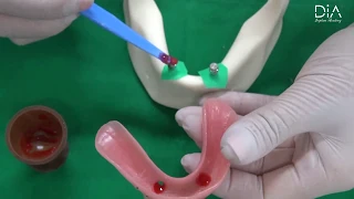 Dental Implant education video overdenture part