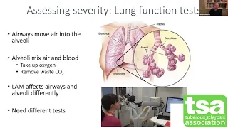 TSC and lymphangioleiomyomatosis (LAM)