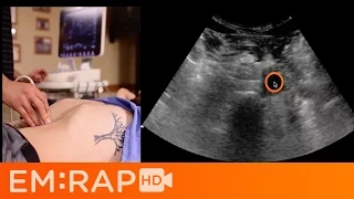 Ultrasound of Abdominal Aortic Aneurysm (AAA)