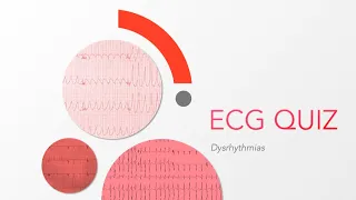 ECG Quiz: Dysrhythmias