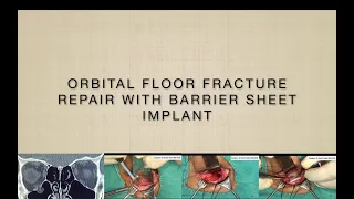Orbital Floor Fracture Repair via Inferior Transconjunctival Approach: Dr Sonal Yadav