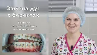 Как заменить дуги в самолигирующих брекетах. Брекеты Самара влог,  braces update