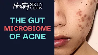 The Gut Microbiome Of Acne [NEW RESEARCH] | Dr. Julie Greenberg