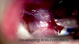 Inferior Pointing ACOM Aneurysm Clipping with Optic Nerve Decompression - Supraorbital Approach