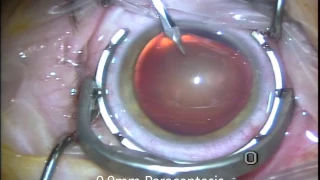 "No-Drops" or "Dropless" Cataract Surgery with Symfony Lens Implant 2016