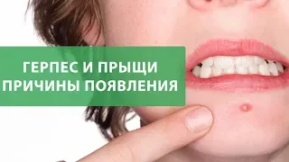 Герпес и прыщи. Как понять в чем причина? Диагностика по Огулову